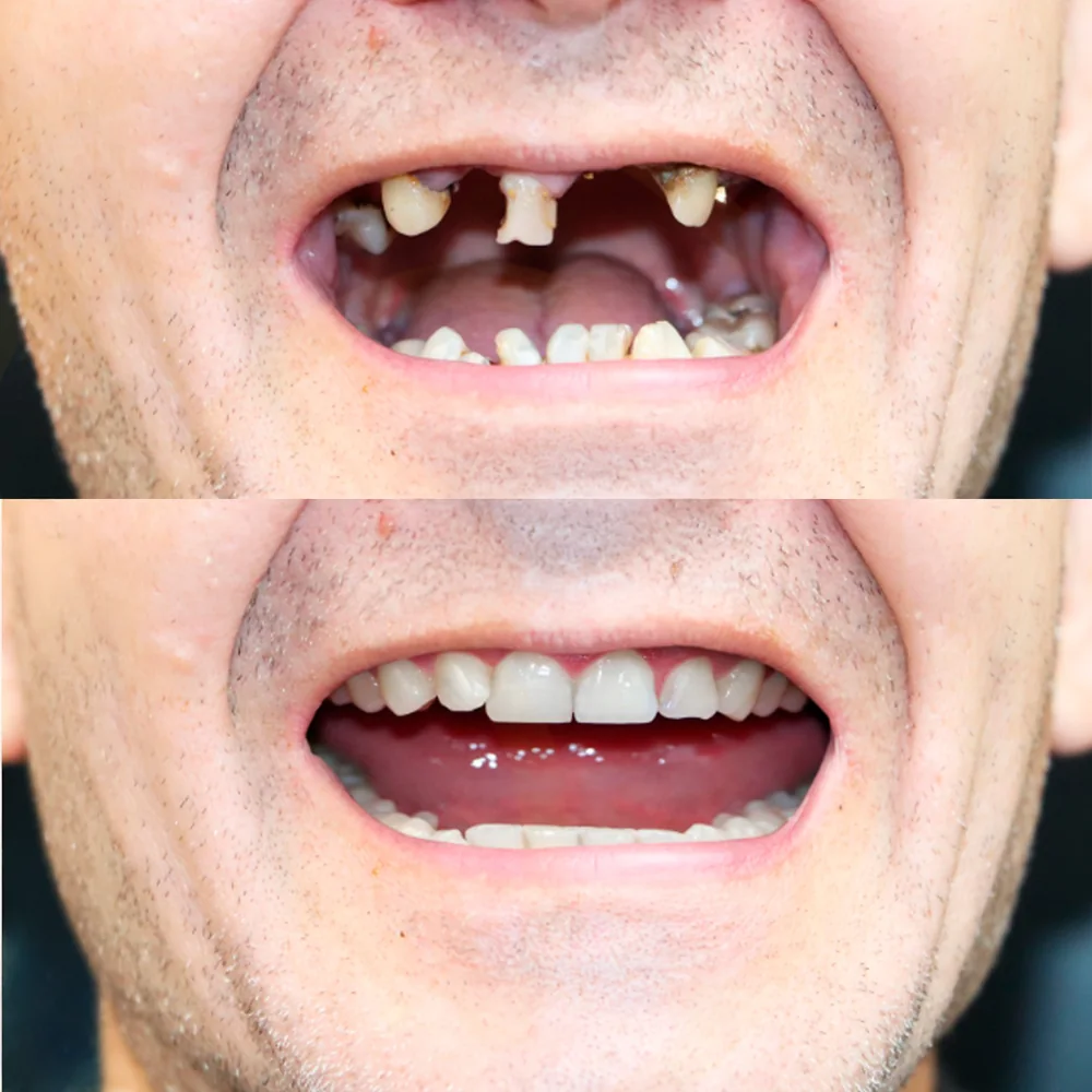 Antes e depois de paciente reabilitado com implantes na Biosorriso