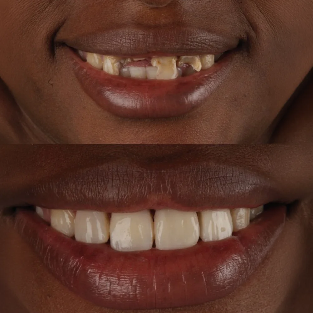 Antes e depois de paciente com o sorriso reabilitado na Biosorriso