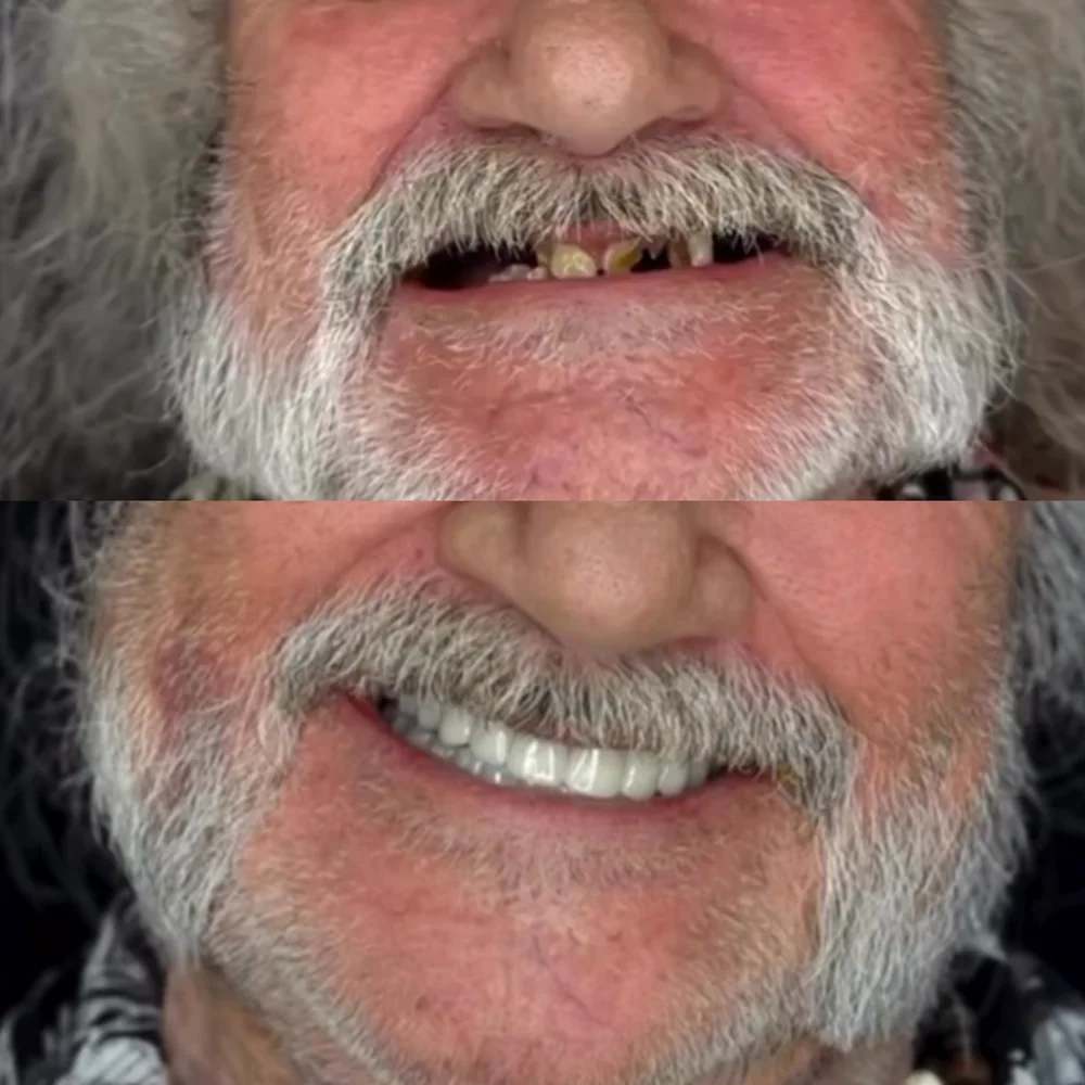 Antes e depois de paciente tratado com prótese fixa sobre implantes na Biosorriso