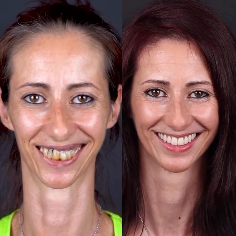 Antes e depois de paciente que recuperou a mastigação na Biosorriso